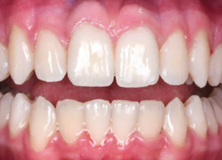 dental-implants-surat-post-treatment-results