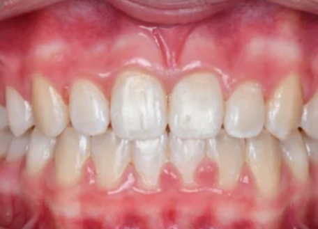 After dental treatment