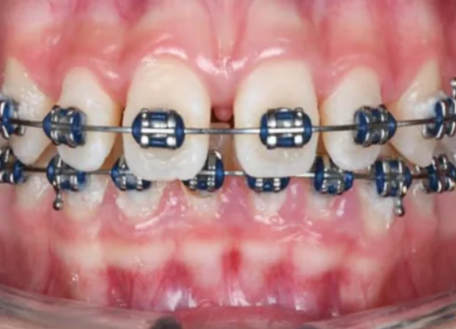 Before dental treatment