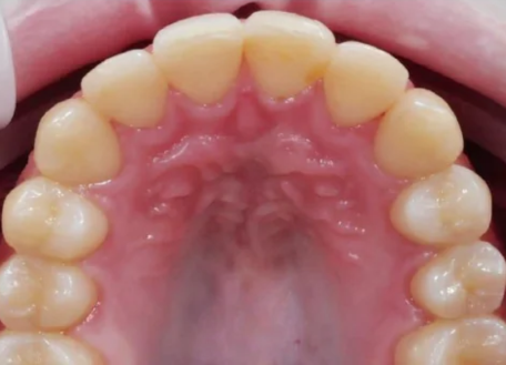 nri-smile-makeover-surat-after-treatment-results