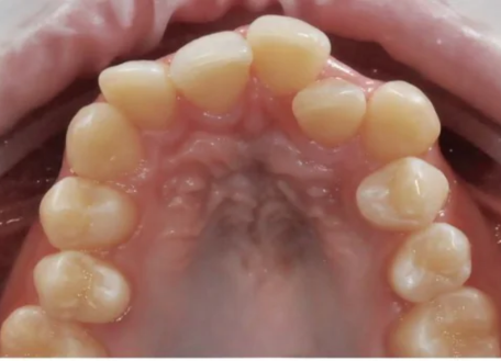 nri-smile-makeover-surat-before-treatment-results